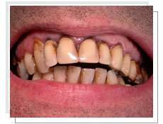 Photo avant l'intervention de la prothse cramique sur dent naturelle 