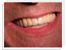 Photo aprs l'intervention de la prothse cramique sur dent naturelle 