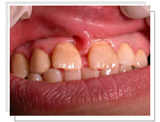 Photos avant l'intervention de l'implantation dentaire conventionnel et liaison avec dents naturelles suprieures