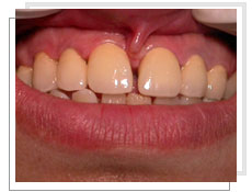 Photos aprs  l'intervention de l'implantation dentaire conventionnel et liaison avec dents naturelles suprieures