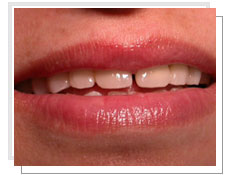Vue de face avant  l'intervention de l'implantation dentaire conventionnel et liaison avec dents naturelles suprieures