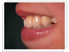 Vue de profil aprs l'intervention de l'implantation dentaire conventionnel et liaison avec dents naturelles suprieures