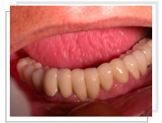 Photo aprs la pose des implants dentaires conventinnels avec liaison dents-implants