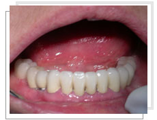 Photo aprs la pose des implants dentaires conventinnels et liaison dents-implants