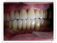 Photo aprs la pose des implants dentaires conventinnels avec liaison dents naturelles: bridge cramique complet fixe avec mise en charge immdiate