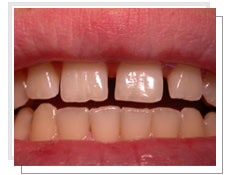 Photo avant le collage des facettes cramiques: les dents sont lgrement mal positionnes
