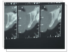 Photo de la radio panoramique dentaire: l'paisseur osseuse est insuffisante