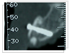 Photo de la radio panoramique dentaire: l'paisseur osseuse est assez favorable aprs la fixation de la greffe osseuse  par un mini-vis