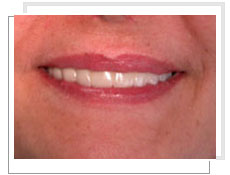 Photo aprs la pose de implants dentaires: aprs 6 mois fixation dfinitive dun bridge fixe de 12 lments cramiques 