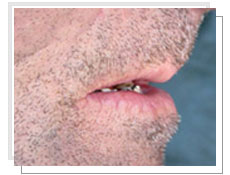 Photo avant la pose de implants dentaires: dentement total suprieur et infrieur 