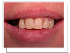 Photo avant la pose de deux implants dentaires de chaque ct droit et gauche: endentement suprieur bilatral 