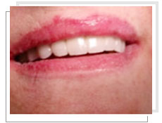 Photo aprs la pose de implants dentaires: aprs 6 mois fixation dfinitive dun bridge fixe de 12 lments cramiques 