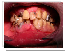 Photo avant l'intervention de l'extraction et l'implantation immdiate: 2 prothses mobiles anciennes dfectueuses prenant appui sur des dents