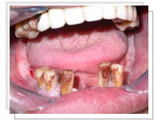 Photo avant l'extraction de toutes les dents infrieures et la pose des implants immdiatement: les dents infrieures sont dchausses et mobiles