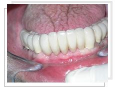 Photo aprs l'extraction de toutes les dents infrieures et la pose des implants immdiatement