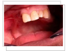 Photo avant l'opration de l'extraction et la pose des implants immdiatement: les dents infrieures sont en mauvais tat 