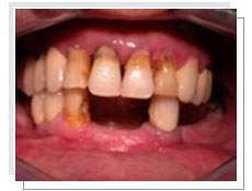 Photo avant l'opration de l'extraction et la pose des implants immdiatement: les dents infrieures sont en mauvais tat 