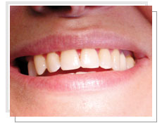 Vue de face avant la pose de 3 implants dentaires avec mise en charge immdiate: absence de la 2me prmolaire et la molaire droite
