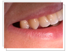 Vue de profil avant la pose de 3 implants dentaires avec mise en charge immdiate: absence de la 2me prmolaire et la molaire droite