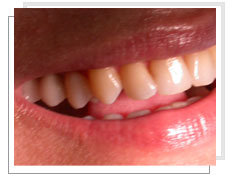 Vue de profil aprs la pose de 3 implants dentaires avec mise en charge immdiate