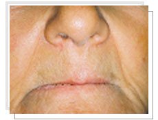 Vue de face avant l'implantologie dentaire avec mise en charge immdiate: dentement total suprieur et infrieur