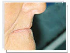 Vue de profil   avant l'implantologie dentaire dentaires avec mise en charge immdiate: dentement total suprieur et infrieur 