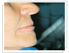Vue de profil  aprs l'implantologie dentaire dentaires avec mise en charge immdiate