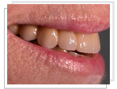 Photo aprs la  pose de 6 implants dentaires et mise en charge immdiate par bridge cramique complet