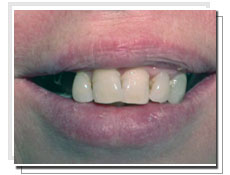 Photo avant la pose d'implants dentaires conventiels: endentement bilatral