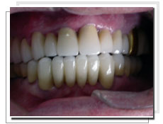Photo aprs la pose d'implants dentaires avec mise en charge immdiate: liaison dents-implants