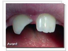 Photo avant l'obturation esthtique: dent dlabre 