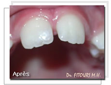Photo aprs l'obturation esthtique: dent reconstitue 