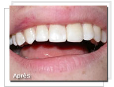  Photo aprs l'obturation esthtique: dents reconstitues