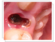 Photo avant  l'extraction et l'implantation dentaire avec mise en esthétique immédiate: descellement répète d’une prothèse provisoire sur une canine supérieure assez délabrée