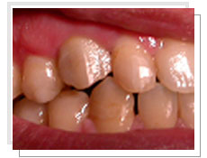 Photo après  l'extraction et l'implantation dentaire avec mise en esthétique immédiate: la fixation d'une prothèse provisoire immédiate sur l’implant